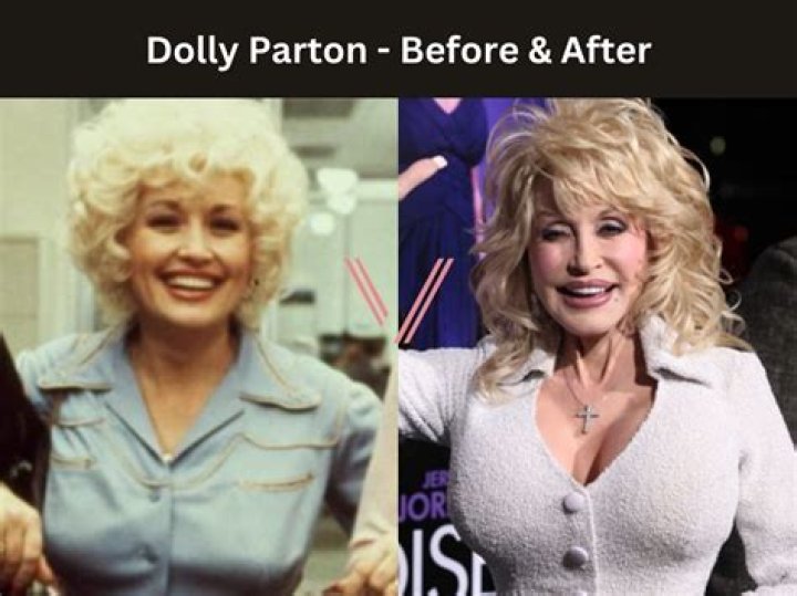 Dolly Parton's Breasts Real Or Enhanced?