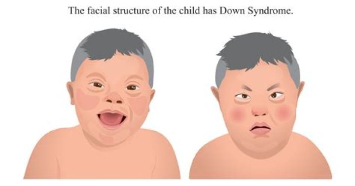 Is George Clooney's Child Affected By Down Syndrome?
