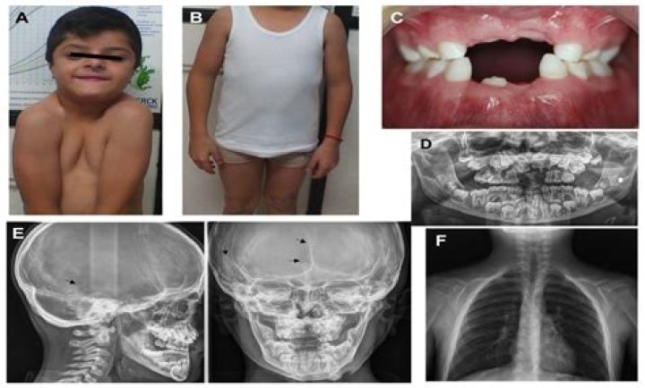 Unveiling The Mysteries Of Actor Cleidocranial Dysplasia